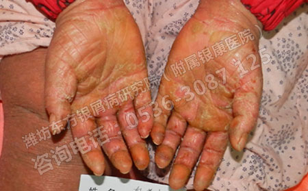 山东治疗牛皮癣的专科医院哪一家可以