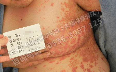 银屑病不传染需要温馨的社会环境
