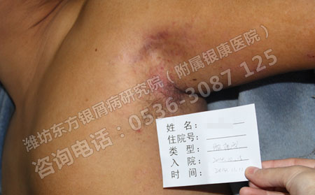 牛皮癣患者春节期间应该注意的事项