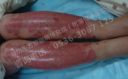 银屑病的遗传和传染是怎样的