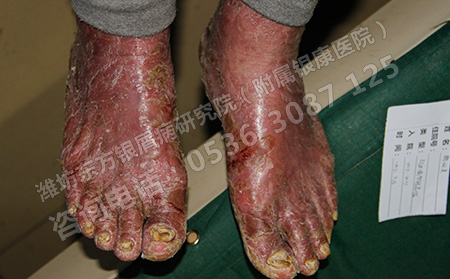 关节型银屑病患者如何护理关节