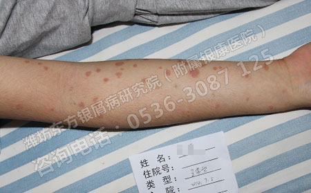 为什么治疗银屑病需要巩固呢