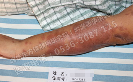 哪家医院治疗银屑病效果非常可以