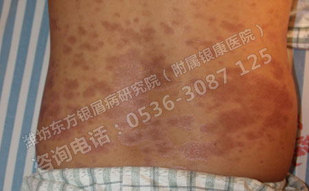 治疗银屑病患者要注意的问题