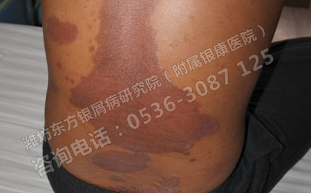 青少年怎么积极有效的预防牛皮癣