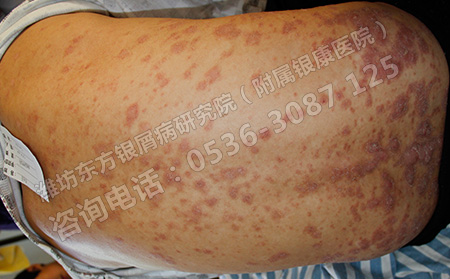银屑病治疗期间要注意哪些禁忌