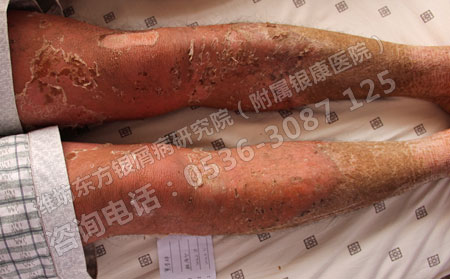 牛皮癣可能产生哪些危害