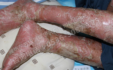 银屑病发生给患者造成的伤害有哪些