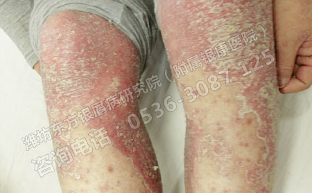 银屑病患者怎样调节心理状态