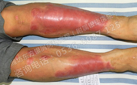 为什么人们认为银屑病传染?真相是什么