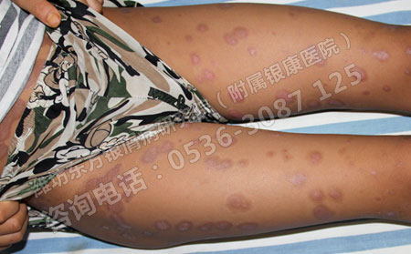 银屑病患者要避开哪些问题