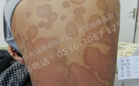 预防银屑病复发的方法是什么