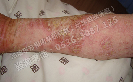 春季到来有牛皮癣要怎样去预防可以？