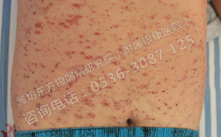 银屑病会对患者身体造成什么危害