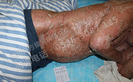 焦点关注：银屑病一定要巩固治疗