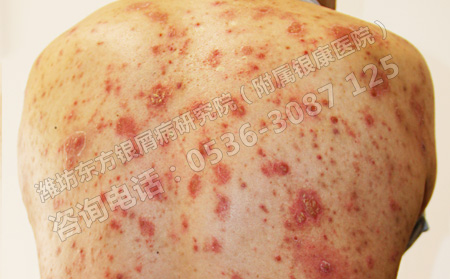 寻常型银屑病使用其他方治疗的时候要注意什么