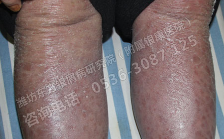 为什么寻常型银屑病不能使用激素药物