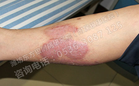 为什么潍坊银屑病医院治疗银屑病更可以