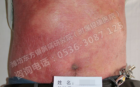红皮型银屑病治疗恢复后怎么避免复发