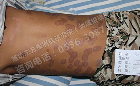儿童银屑病饮食注意什么问题