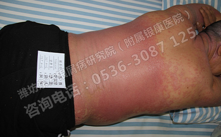 中医治疗银屑病哪些优势