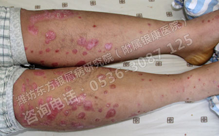 春季关于银屑病的治疗方法有哪些