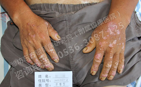 春季银屑病复发后如何进行护理