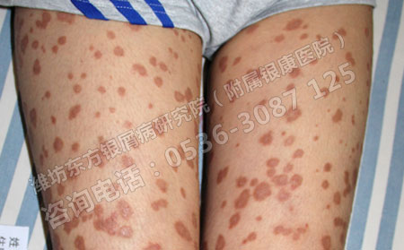 寻常型银屑病治疗药物排名