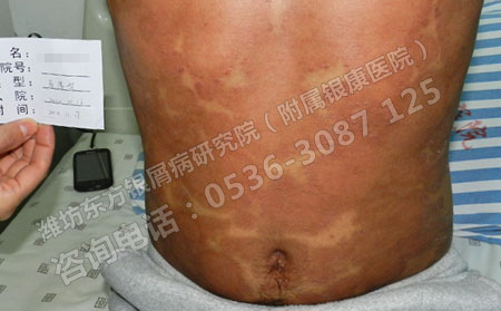 多年银屑病治疗要注意什么
