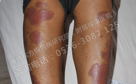 怎么才能做可以银屑病的日常护理