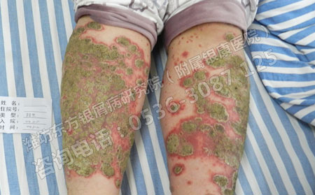 春季怎么治疗才能避免银屑病扩散