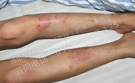 寻常型银屑病要怎么治疗才能可以得快