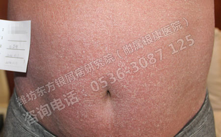 寻常型银屑病加重后有哪些症状