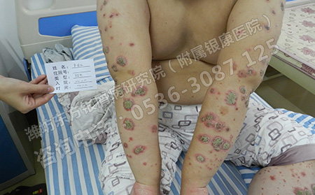 银屑病要怎样进行护理才有效