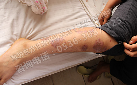 银屑病在治疗过程中为什么突然病情加重