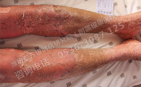 寻常型银屑病有什么办法可以减少恶化