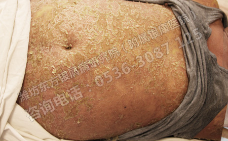 面对银屑病的反复发作应该如何治疗