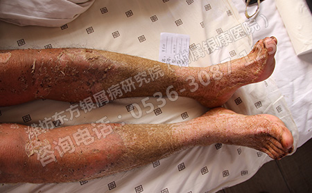 银屑病的出现会给患者带来哪些危害