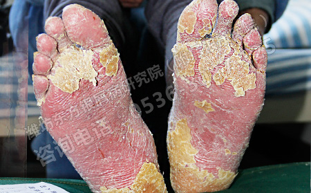 如何有效治疗关节型银屑病