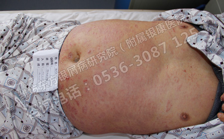 银屑病患者在治疗的时候有哪些禁忌