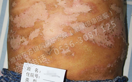 银屑病在日常生活中会有哪些症状