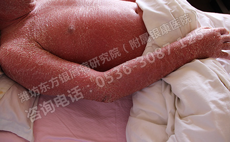 老年银屑病要如何护理才可以呢