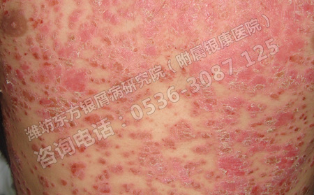 银屑病到底有没有传染性呢