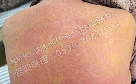 如何预防银屑病在春季加重