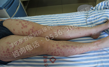 银屑病患者在生活中有哪些禁忌