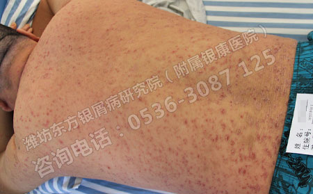 潍坊银屑病医院治疗银屑病怎么样
