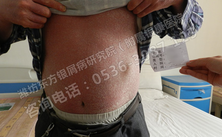 银屑病患者在生活方面有哪些禁忌呢