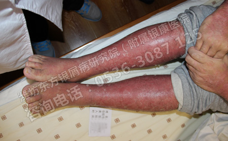 老年银屑病发生在腿部应该如何治疗