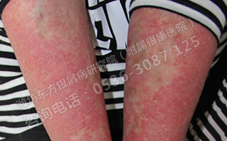 女性得了牛皮癣会受到哪些严重影响