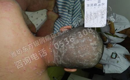青少年患者了银屑病会对身体产生哪些影响